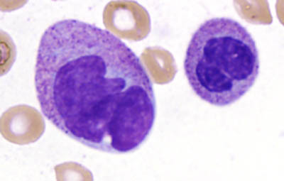 Fig 1D BMA dysmorphic granulopoiesis
